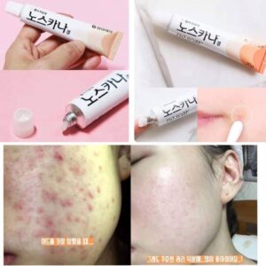 kem trị sẹo noscarna hàn quốc