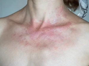 bệnh về da thường gặp vào mùa hè